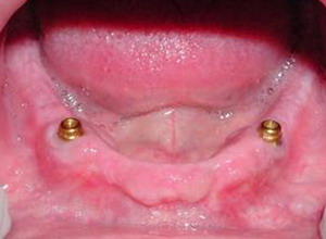overdenture